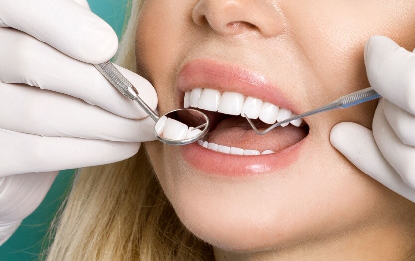 Dental Veneers and their Rising Popularity - ADC