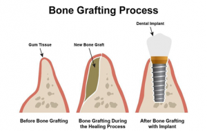 Cosmetic Dentist in Dubai- Bone Grafting Process
