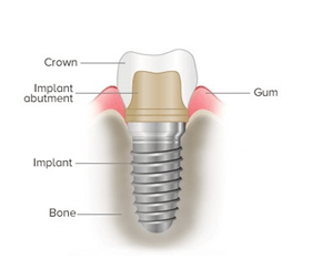Dental Implant - American Dental Clinic