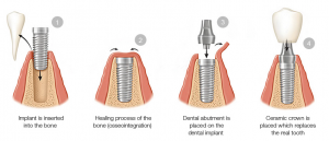 Cosmetic Dentist in Dubai -Dental Implant